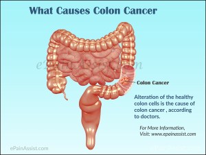 colon-cancer-preview